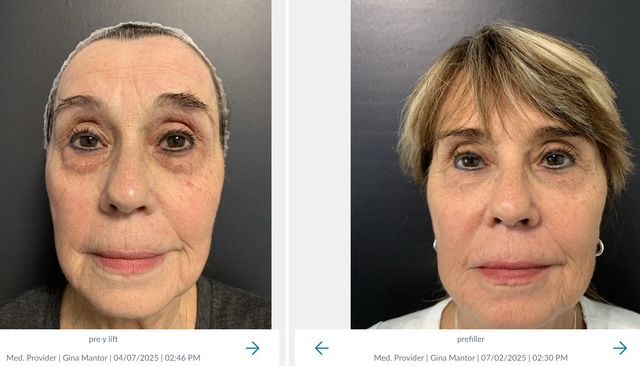 beuatiful aptient results after The Y-lift performed by Dr. Gina Mantor
