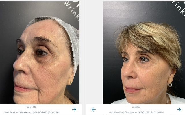 patient side view of y-lift, non-surgial facelift performed by Dr. Gina Mantor