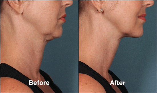 Dermal Fillers — Woman Before And After Kybella in Columbus, OH