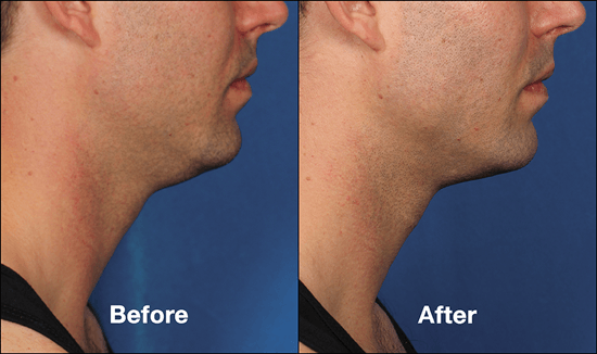 Emsella — Man Before And After Kybella in Columbus, OH