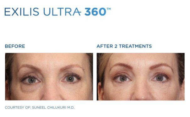 Dr. Mantor's Wrinkle and Weight Solutions, LLC - Westerville, Oh - Medical spa - exilis ultra around eyes