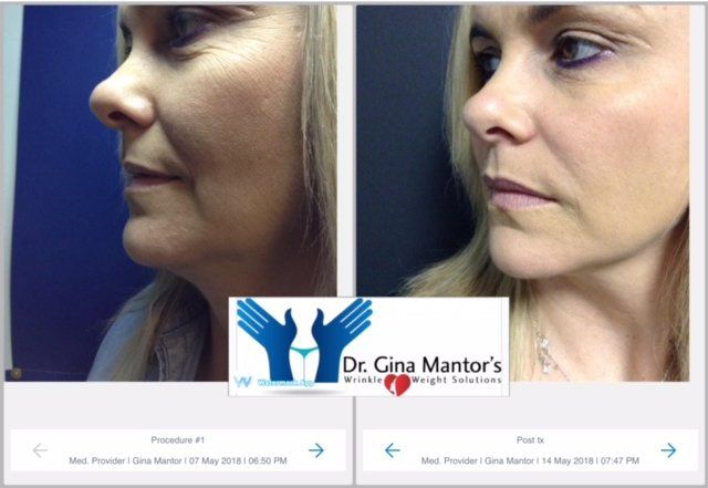 Platelet-Rich Plasma — Befor And After Crows Feet Procedure in Columbus, OH