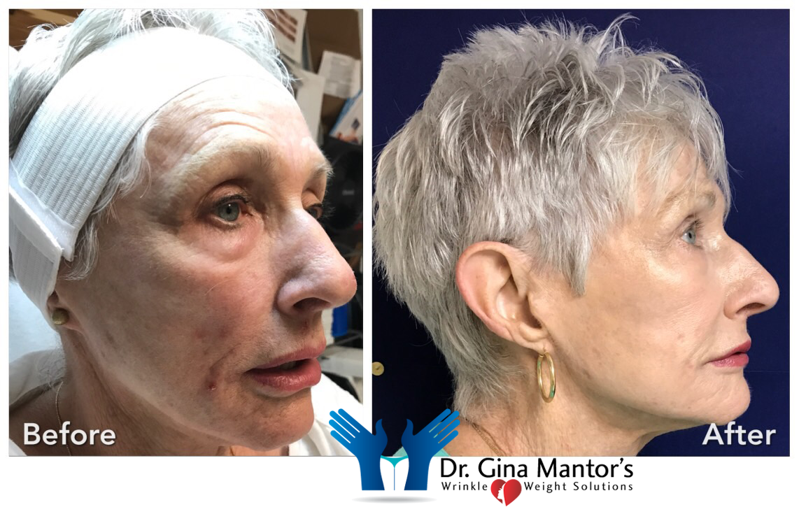 Vollure — Old Woman Before And After Treatment in Columbus, OH