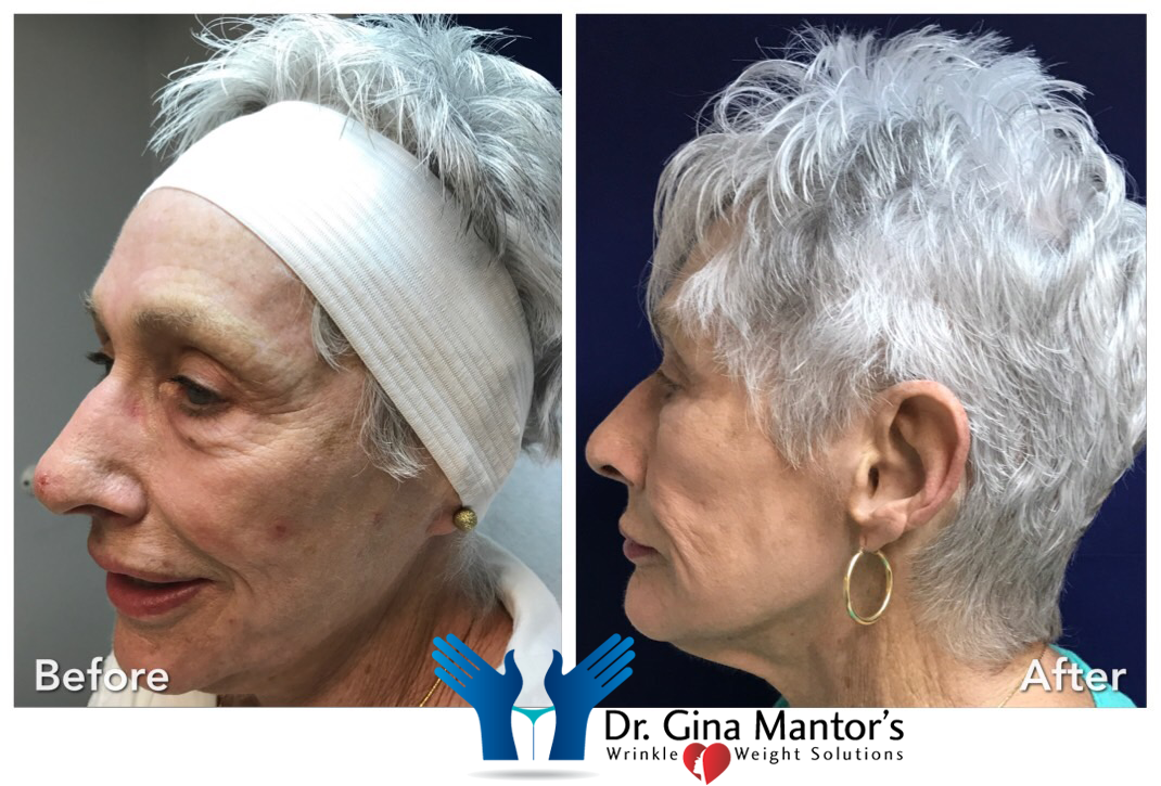Volbella — Left View Of An Old Woman Before And After Procedure in Columbus, OH