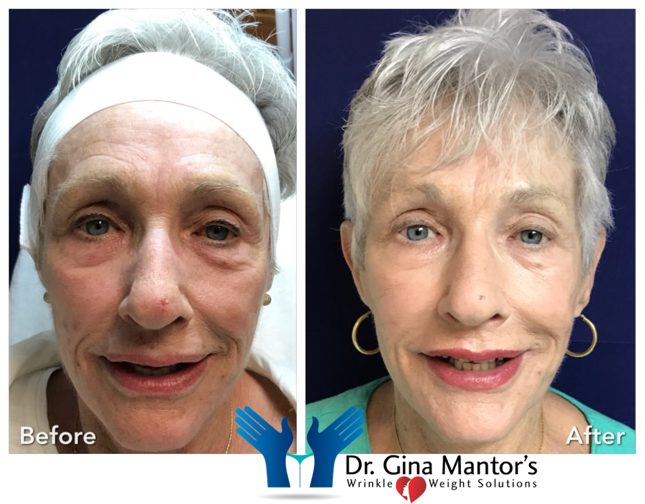 Defyne — Front View Of An Old Woman Before And After Treatment in Columbus, OH