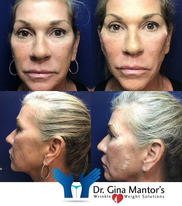 Rejuvenation — An Old Woman On Her Thread Lift Treatment in Columbus, OH