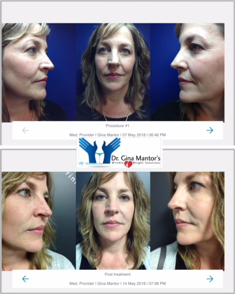 Juvederm Ultra — Woman's Face Before And After Juvederm Treatment in Columbus, OH