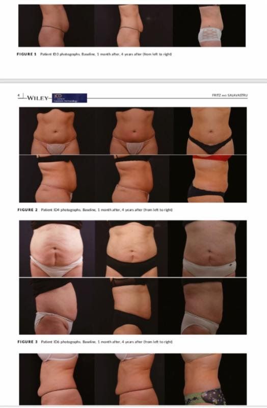 Body Solutions — Before And After Abdomen Part Lipotherapy in Columbus, OH