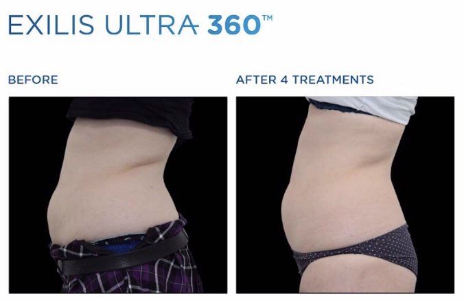 emsculpt progress at  at Dr. Mantor's Wrinkle and Weight Solutions, LLC in Westerville, OH