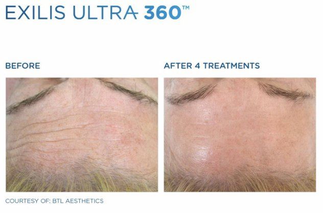 exilis progress at  at Dr. Mantor's Wrinkle and Weight Solutions, LLC in Westerville, OH