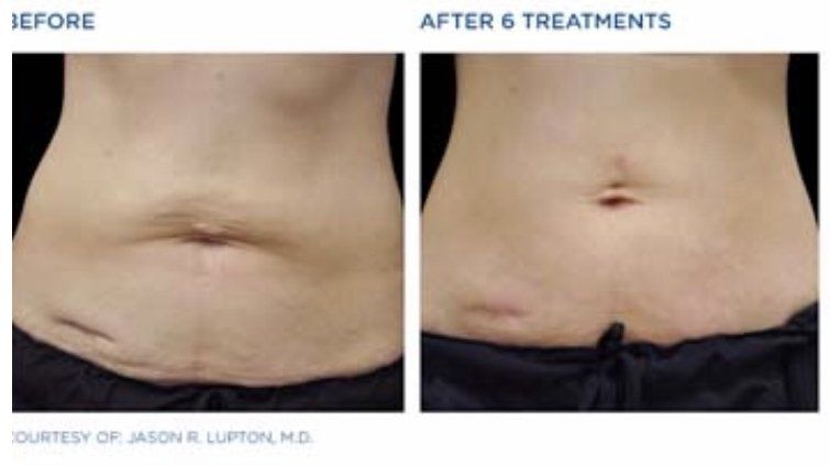 male patient progress at  at Dr. Mantor's Wrinkle and Weight Solutions, LLC in Westerville, OH
