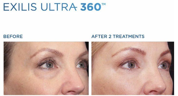 Dr. Mantor's Wrinkle and Weight Solutions, LLC - Westerville, Oh - Medical spa - exilis ultra 360 results