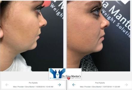 Kybella Before and After — Columbus, OH — Dr. Mantor's Wrinkle and Weight Solutions LLC