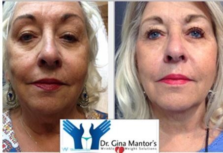 PDOthreads Before and After — Columbus, OH — Dr. Mantor's Wrinkle and Weight Solutions LLC