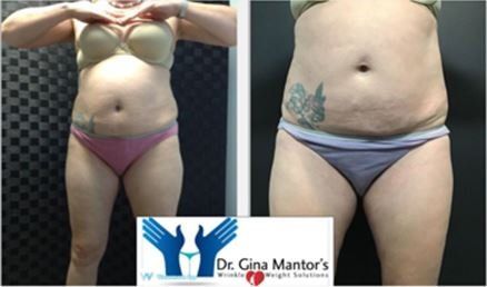 Vanquishme Before and After — Columbus, OH — Dr. Mantor's Wrinkle and Weight Solutions LLC