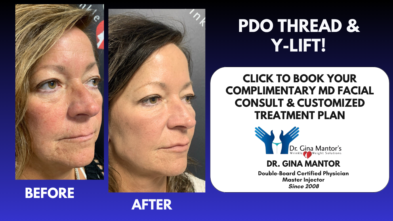 PDO Thread Lift and Y- Patient Results at WrinkleandWeight.com