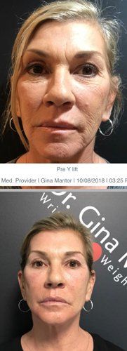 Y-Lift — Before And After Result After Y-Lift Procedure in Columbus, OH