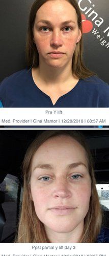 After Y-Lift Procedure — Front View Of A Young Woman Before And After Procedure in Columbus, OH