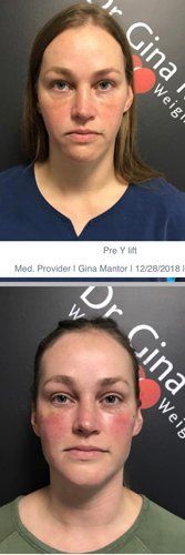 Non Surgical Procedure — Woman Smiled In Her After Portrait After Procedure in Columbus, OH