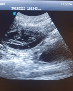 pregnancy scan image