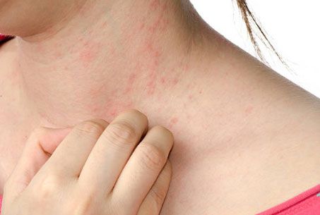 DR. LUIS MIGUEL IRIGOYEN GARIBAY -¿Qué es la dermatitis atópica?