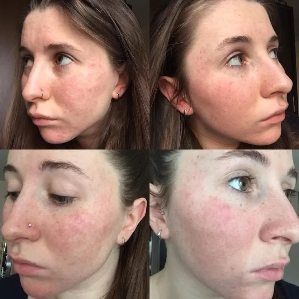 Four photos of a fair-skinned woman with red, blotchy skin on her face.