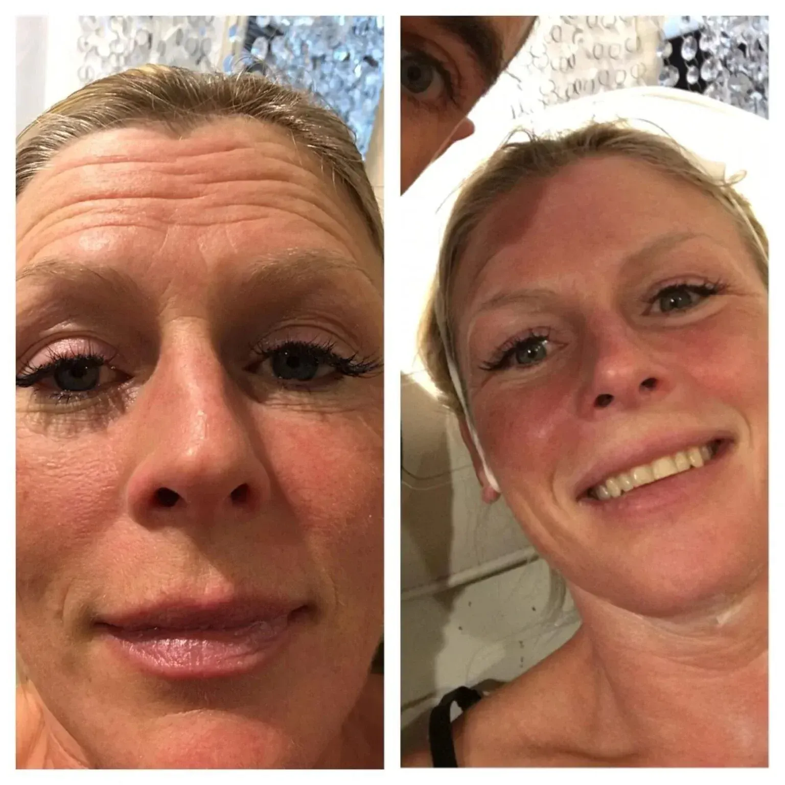 Before and after: Woman with forehead wrinkles on the left, smiling and wrinkle-free on the right.