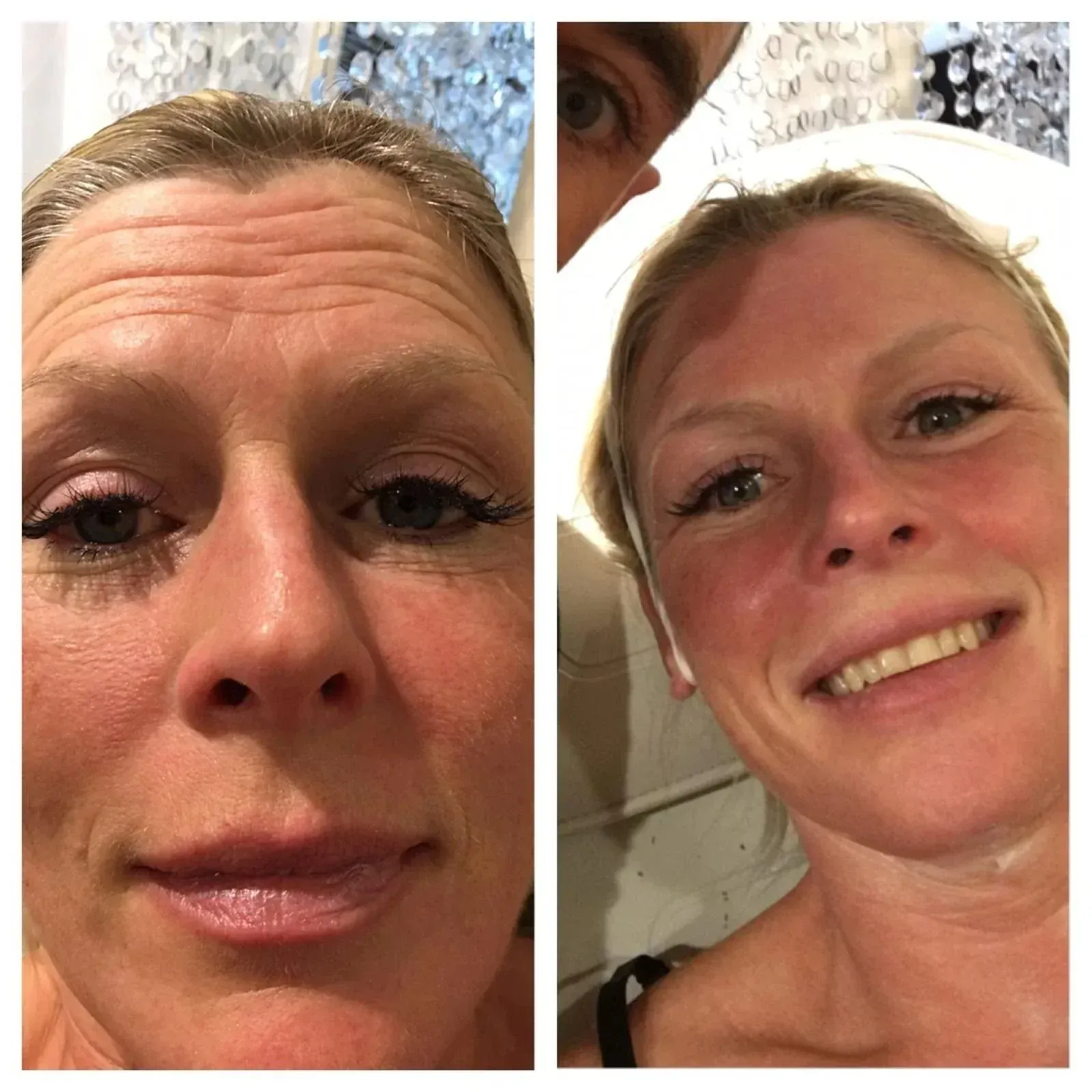 Woman before and after treatment, showing reduction in forehead wrinkles.