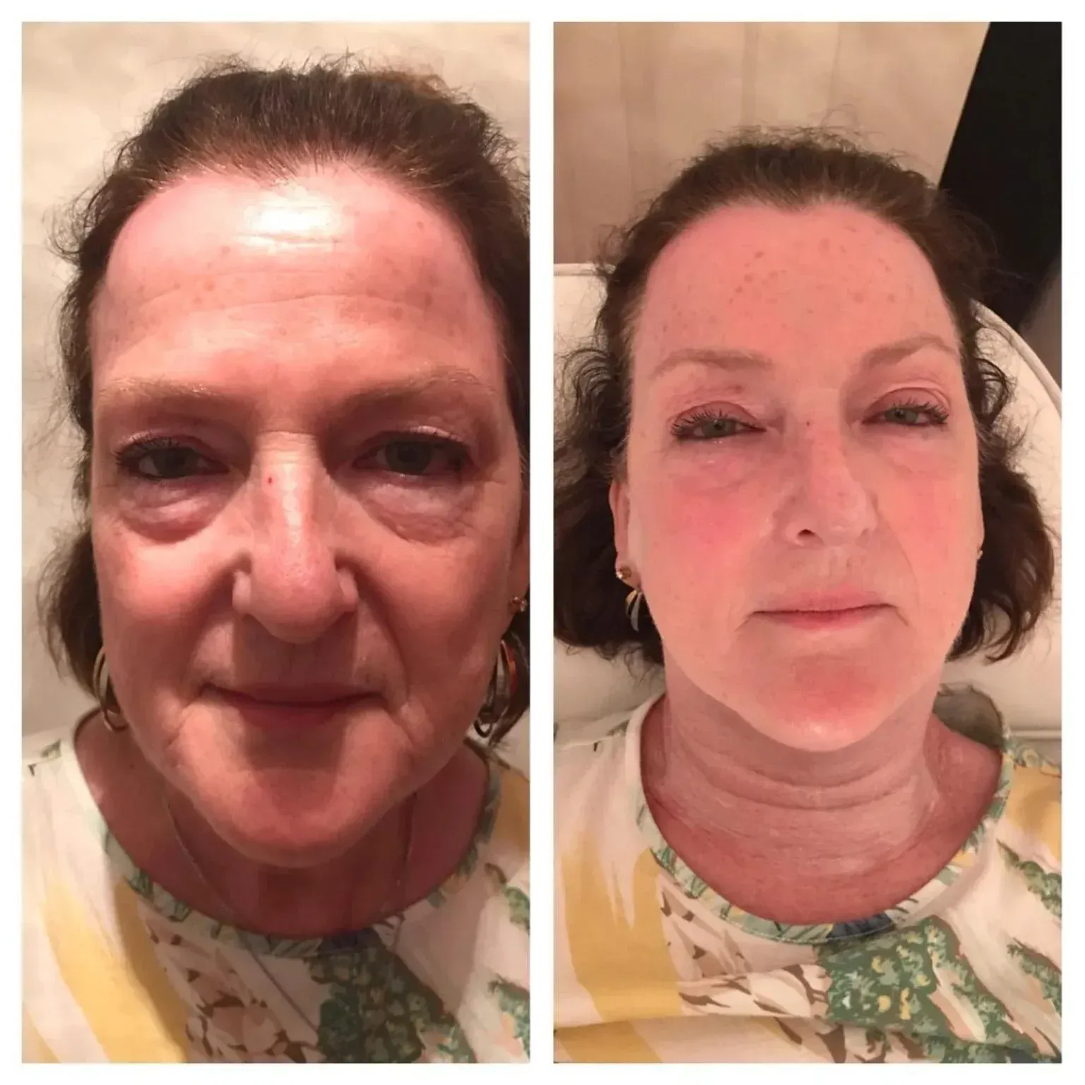 Before and after facial rejuvenation photos of a woman with visible skin changes.