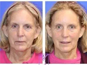 Before-and-after of woman's face. Ears pinned back with surgery, smiling. Pink shirt, fair skin, blonde hair.