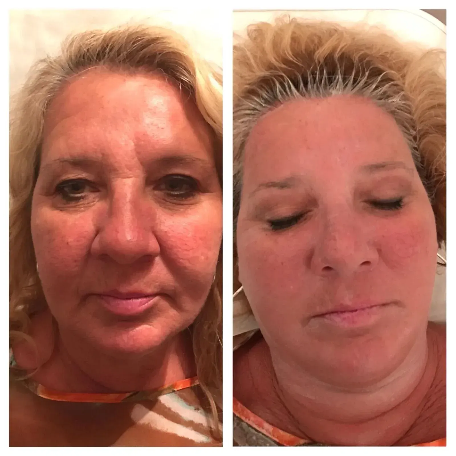 Before and after photos of a woman's face showing reduced wrinkles and redness after a facial treatment.
