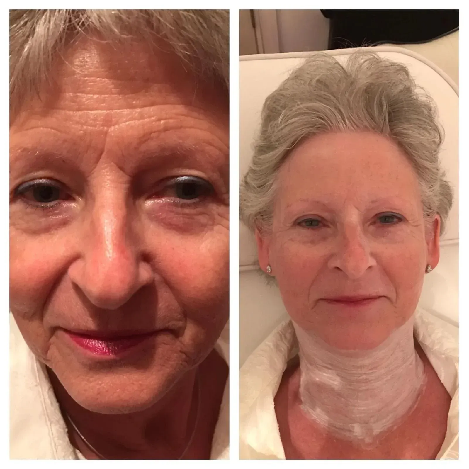 Before-and-after photos of a woman's face; left shows wrinkles, right shows smoother skin with neck wrap.