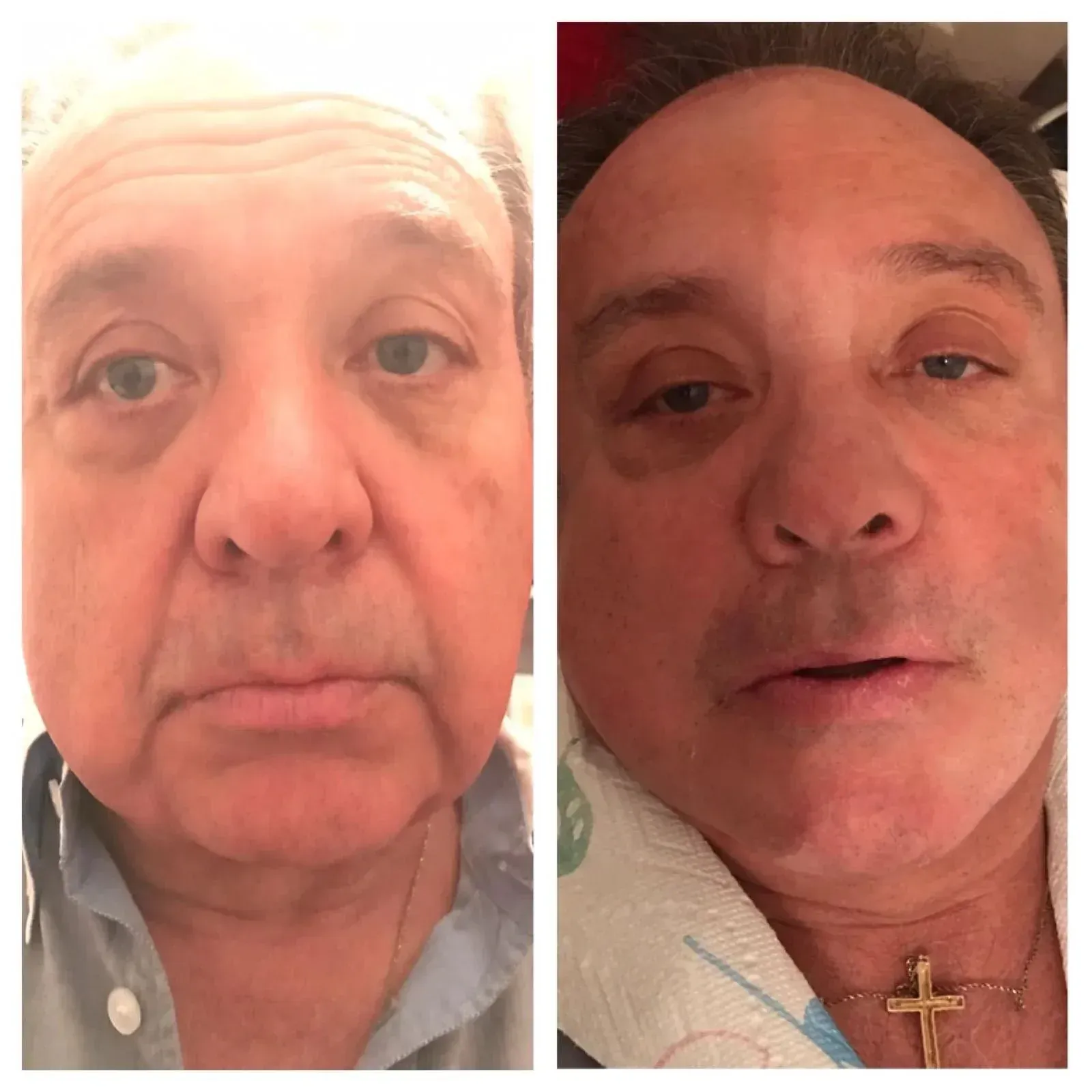 Two side-by-side portraits of a man's face, pre- and post-procedure; left shows wrinkles, right shows smoother skin and swelling.