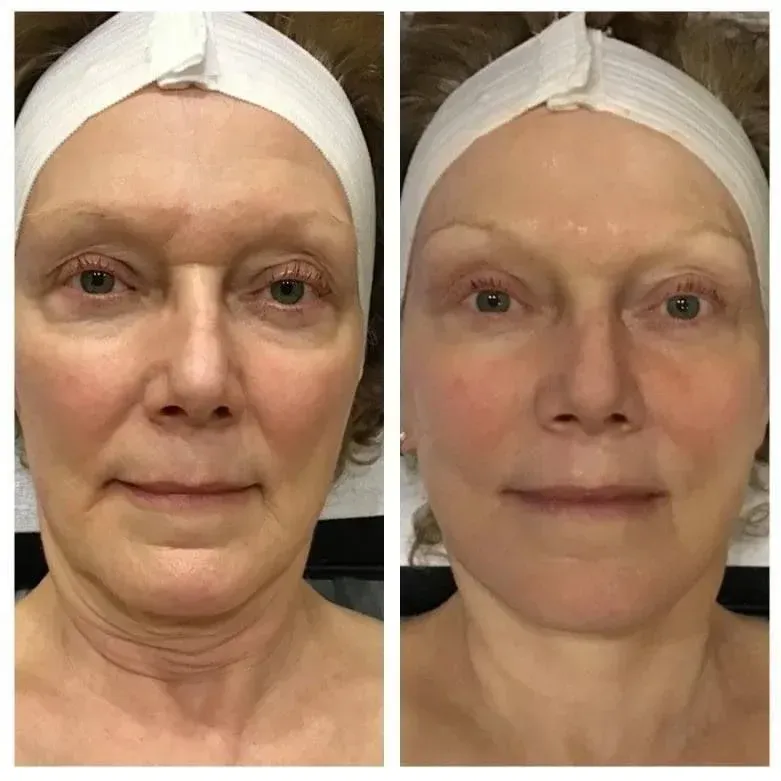 Side-by-side photos of woman's face before and after a skin treatment. Skin appears tighter, smoother and redder on the right.