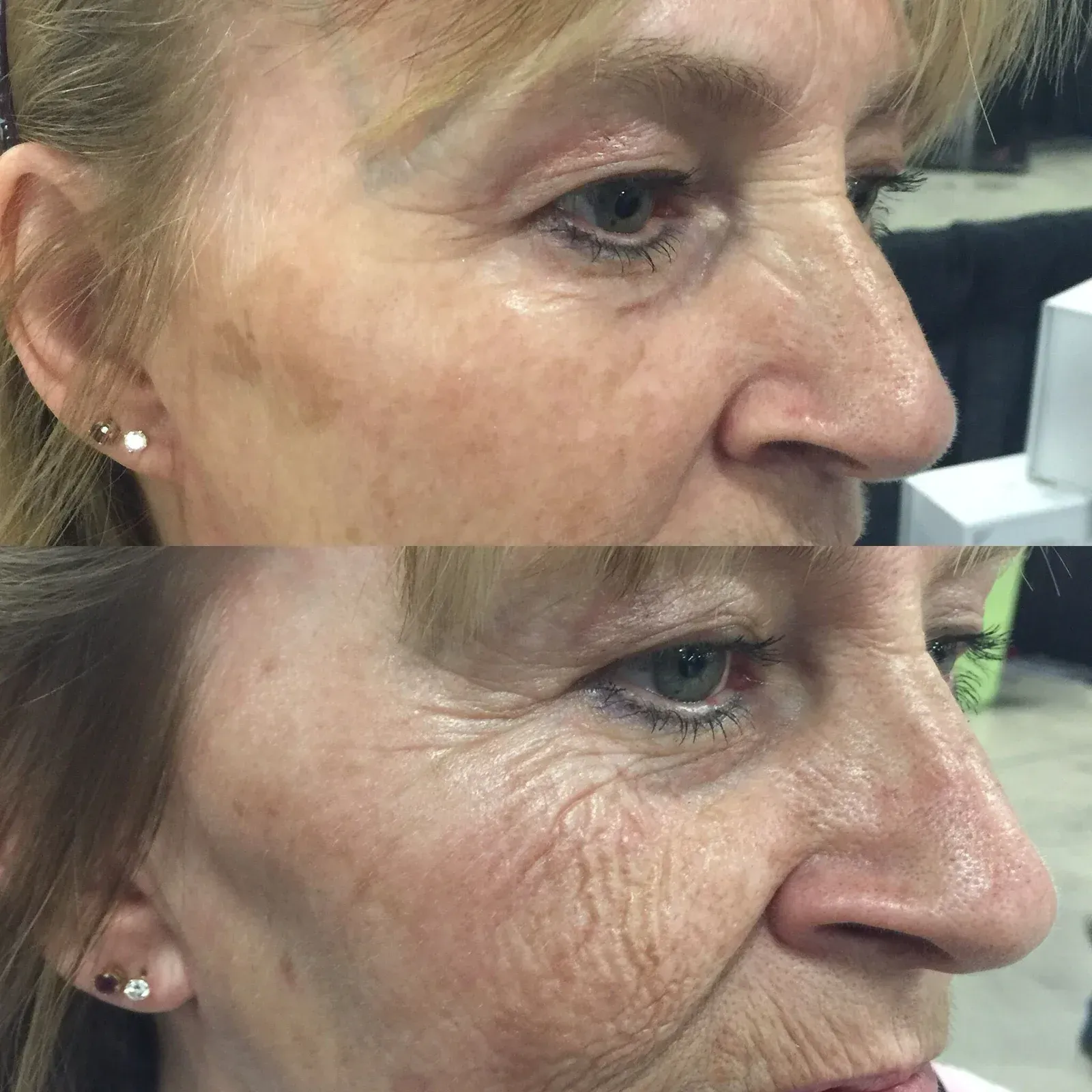 Side-by-side view of woman's face; top shows uneven skin tone, bottom shows skin with more wrinkles.