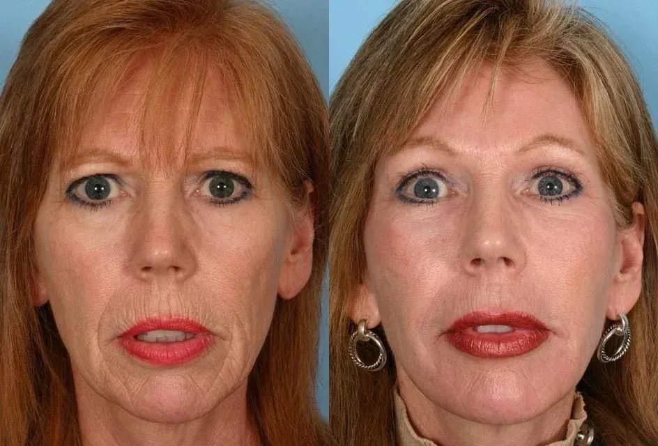 Before and after photos: woman with wrinkles on left, smoothed skin on right. Red hair, lipstick, earrings.