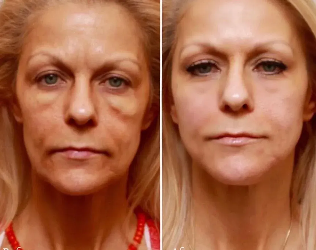 Woman's face before and after cosmetic procedure, showing reduced wrinkles and firmer skin.