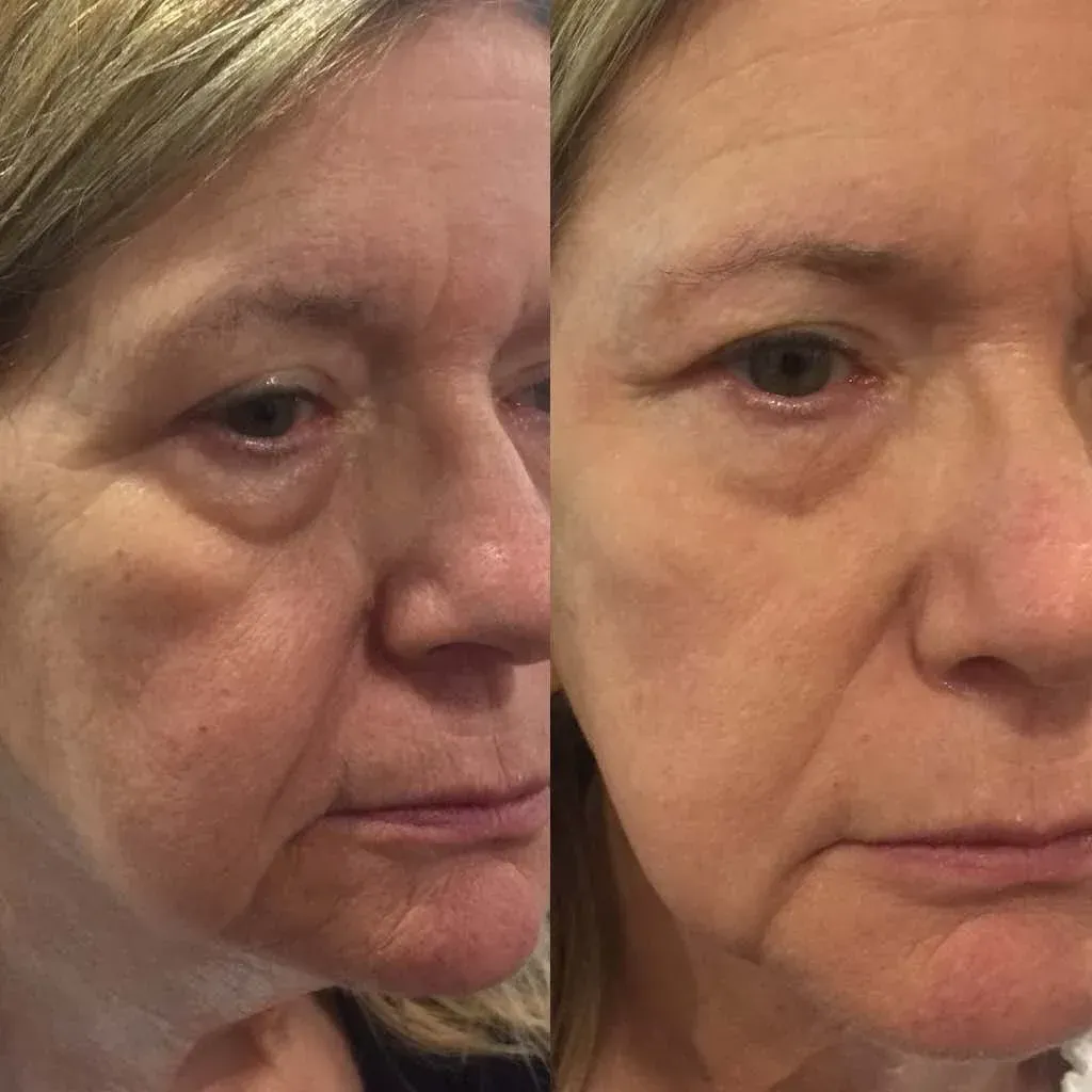 Side-by-side comparison of a woman's face before and after a cosmetic treatment. Smoother skin and reduced wrinkles are visible.