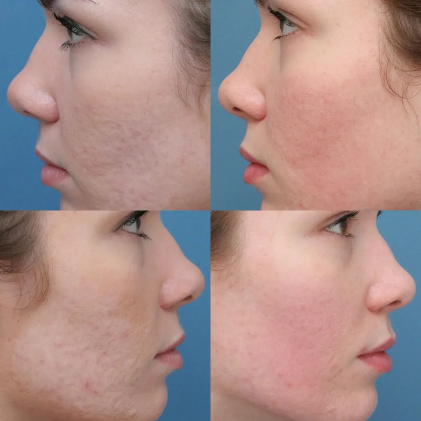 Four photos showing a woman's face from the side, illustrating improvement of acne scars over time.