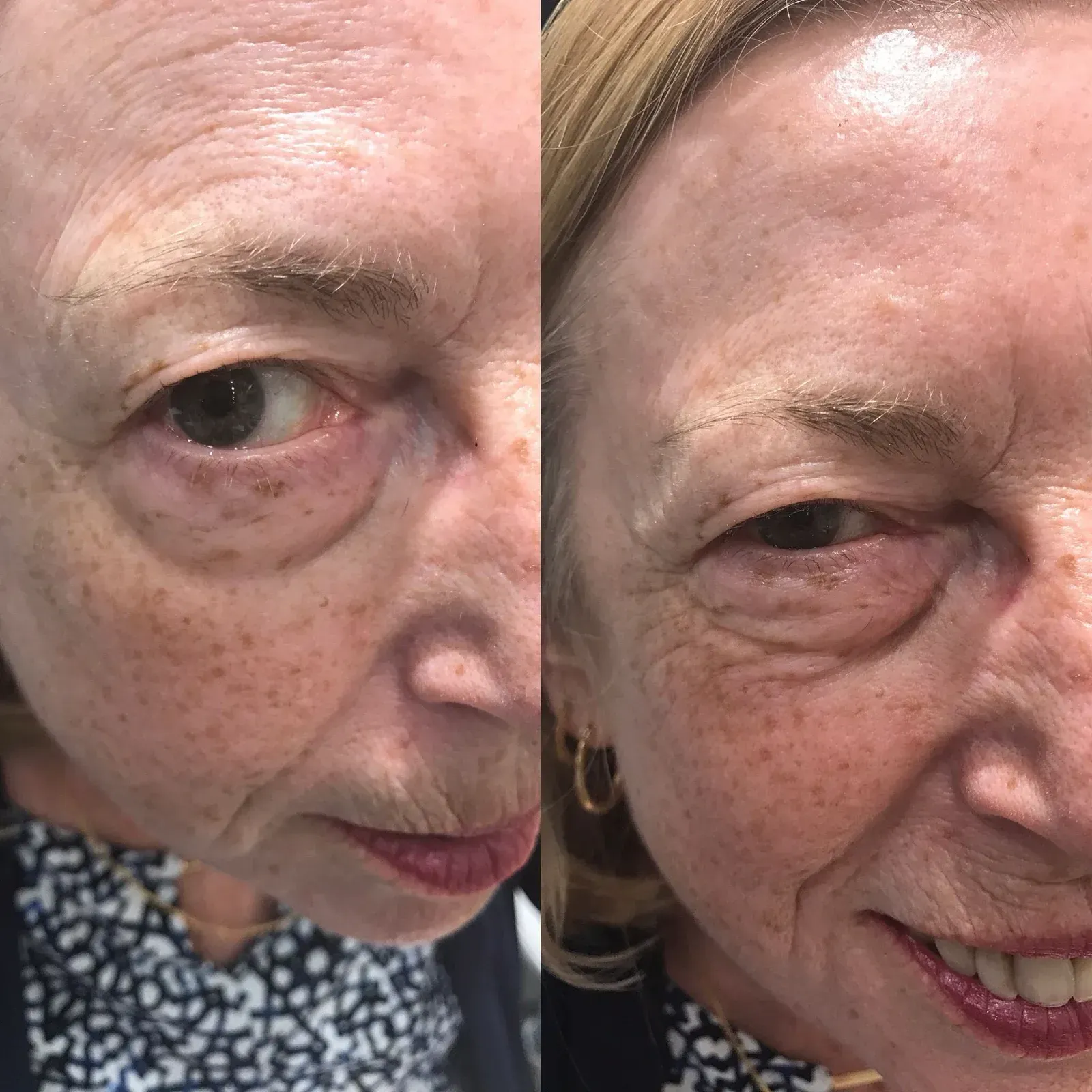 Comparison of a woman's face before and after a cosmetic treatment, showing reduction of wrinkles and improved skin appearance.