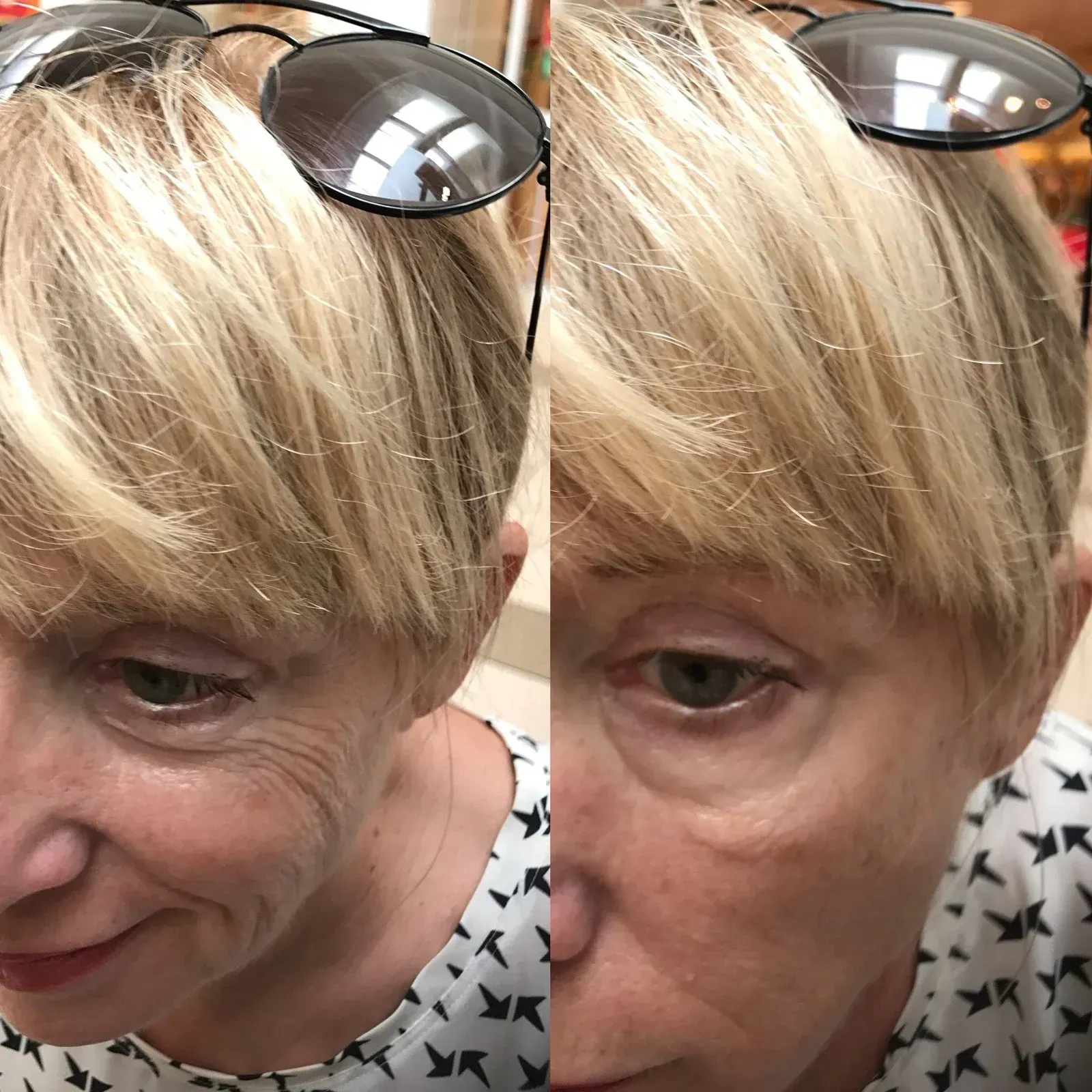 Woman's face, half with wrinkles and expression lines, the other half smoothed. Sunglasses on head, blond hair, white and black patterned top.