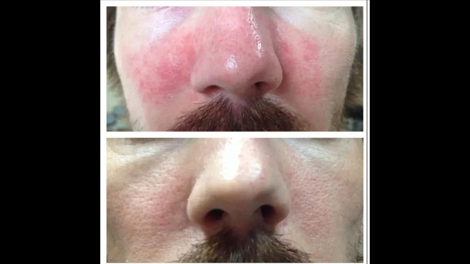 Top: Man's face with red, inflamed skin. Bottom: Same man, skin improved.