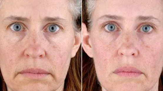 Side-by-side photo: Older woman's face before (wrinkles) and after (smoother skin) a cosmetic procedure.
