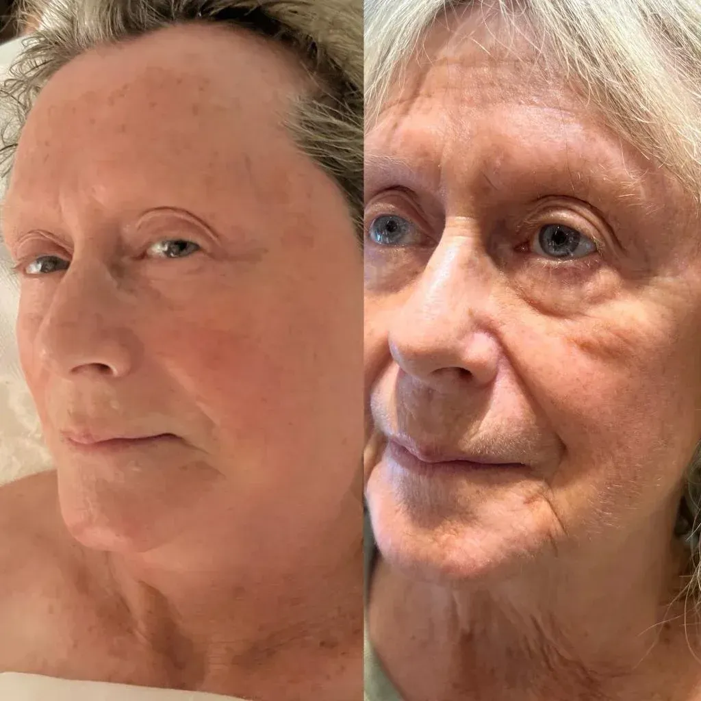 Two side-by-side photos of an older woman's face. She has fair skin and is looking at the camera.