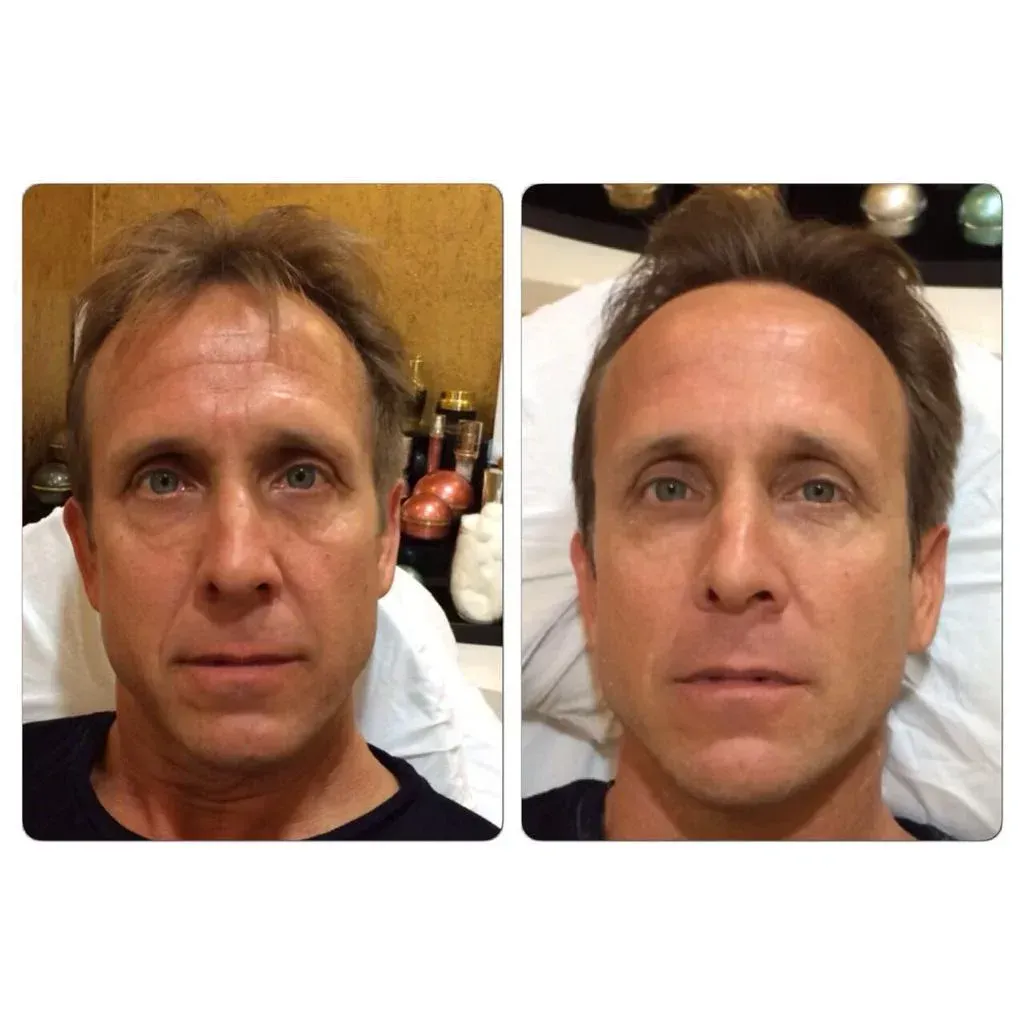 Before and after photos of a man's face, showing reduction in wrinkles and a more youthful appearance.