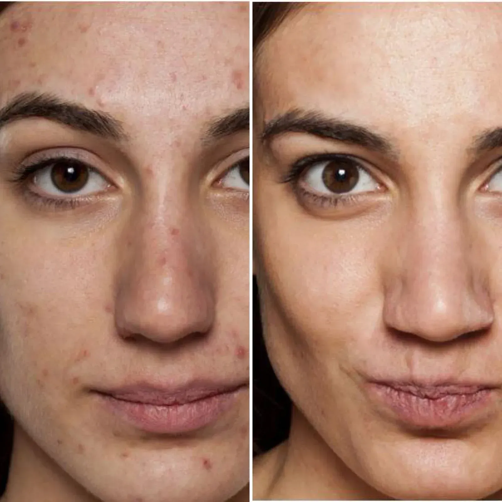 Before and after portraits showing a woman with acne, then with clear skin, brown eyes, natural makeup.