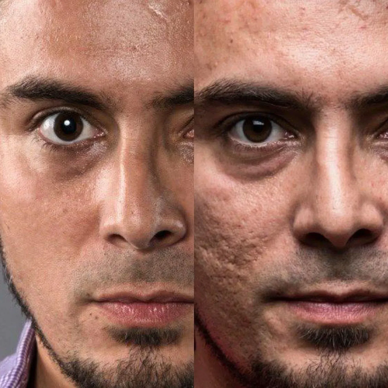 Split face of a man; left side appears smoother, right side shows acne scars.