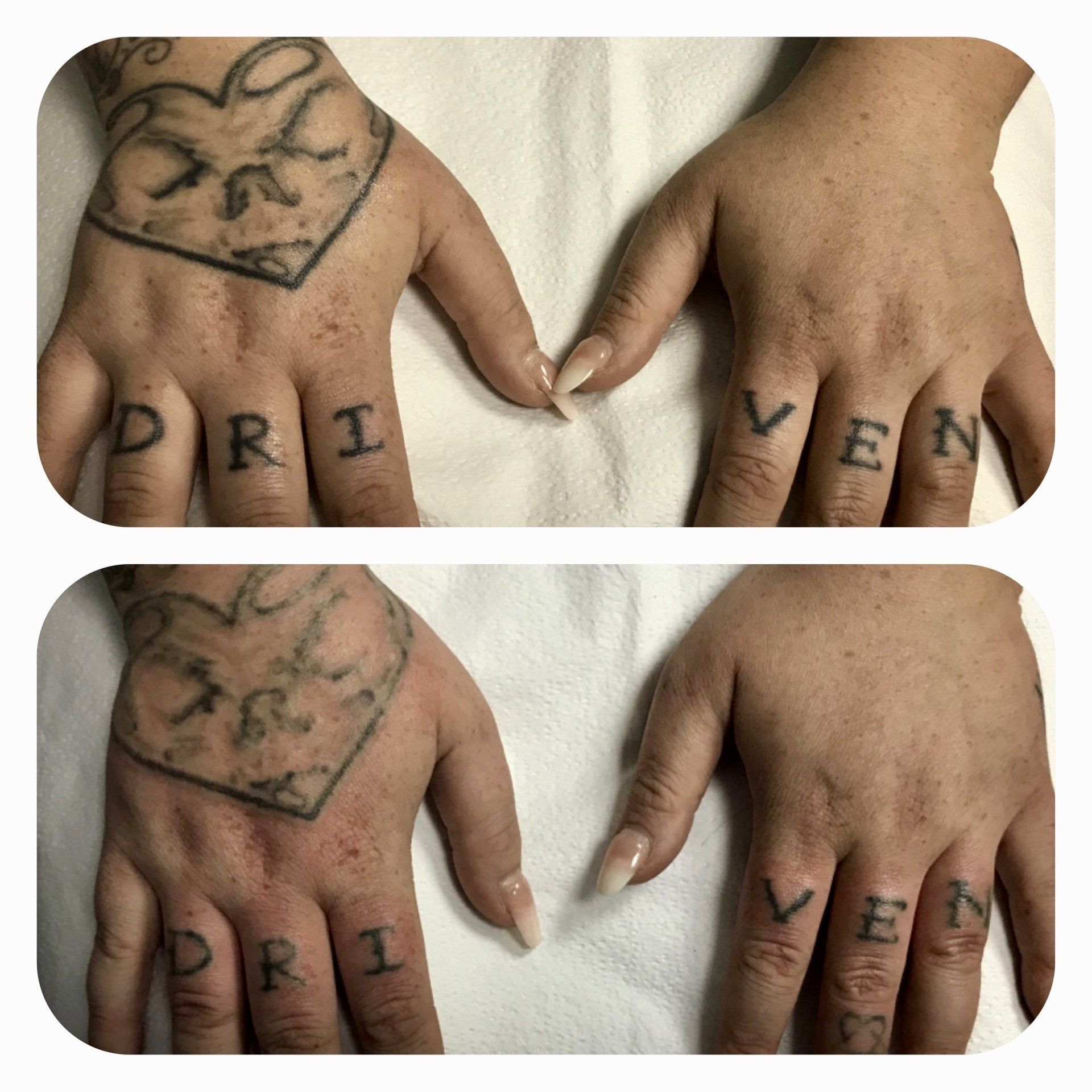 Ellicott City Tattoo Removal