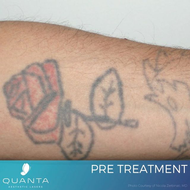 Laser Treatment for Tattoos