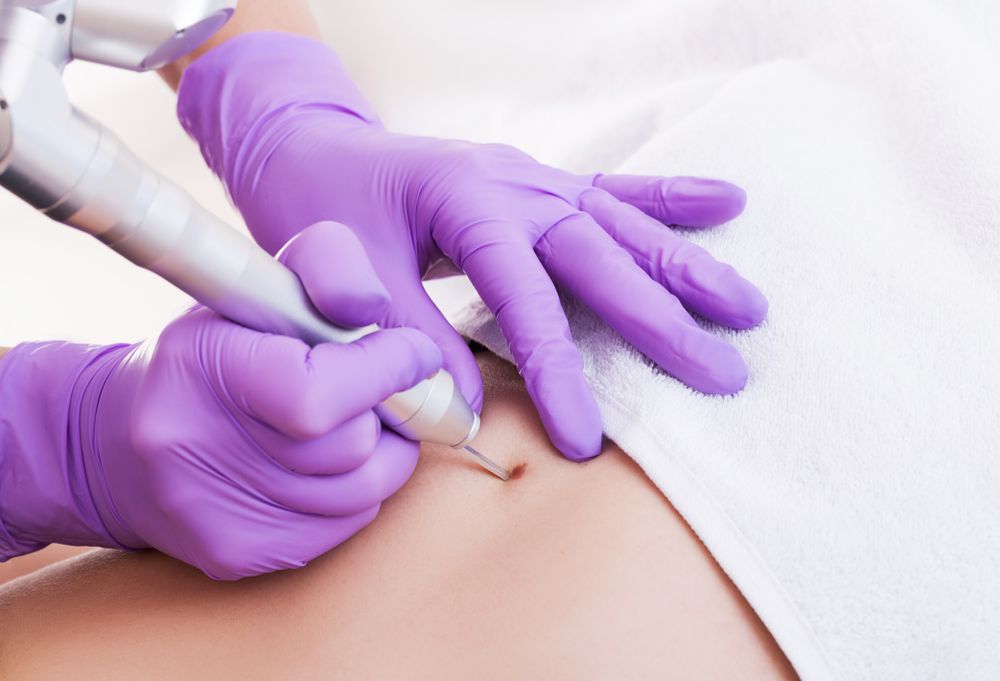 Hands in purple gloves using a laser to treat a skin lesion on a patient's abdomen — Embrace Cosmetic Clinic in Bundaberg North, QLD